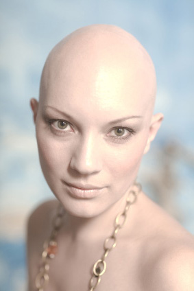 There are many types of female baldness, and female baldness and hair loss can happen to any female, but in this photo, it was caused by a very rare genetic balding condition.