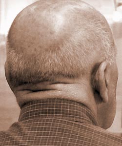 Here you can see an advanced case of male pattern baldness - baldness is medically known as alopecia.